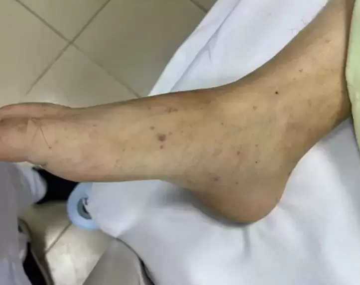 胡志明市一学校出现脑膜炎球菌病例群 家长接种疫苗需求上升 · 报道配图