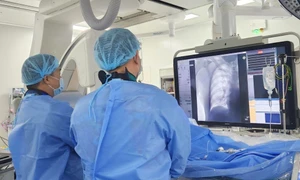 利用二氧化碳血管造影技術為70歲患者保護移植腎