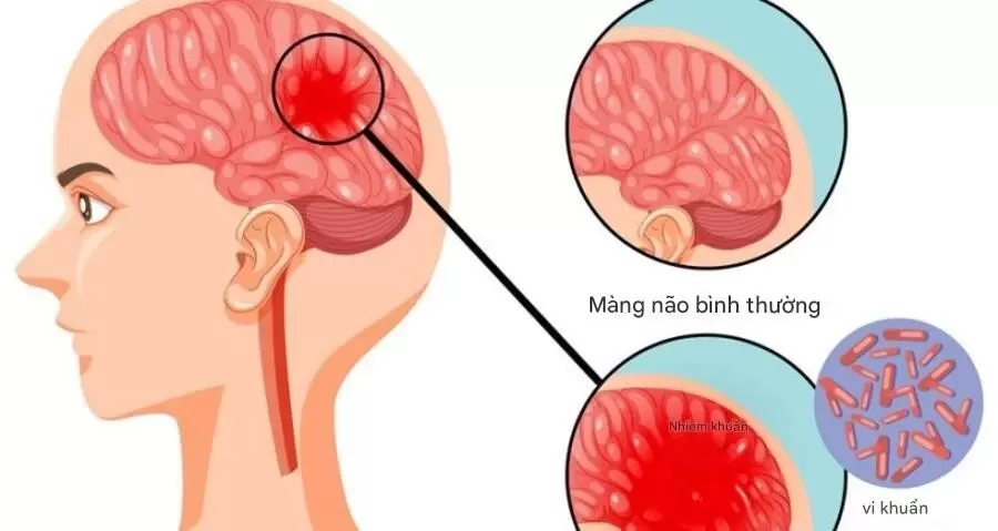 脑膜炎球菌可快速致死,专家警告危险信号