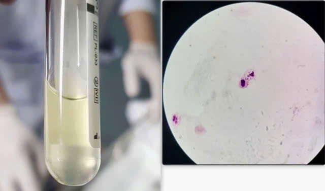 胡志明市一中學三名學生確診腦膜炎球菌感染,一人死亡 · 報道配圖